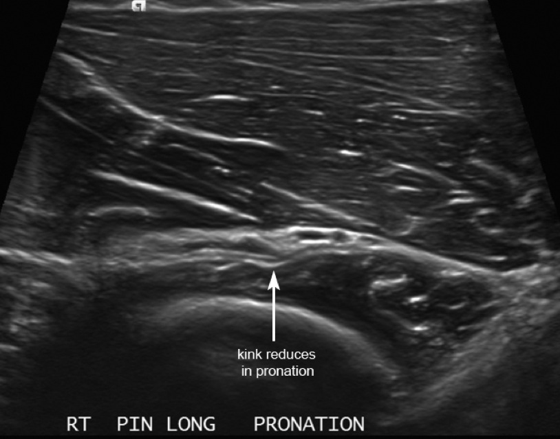 Figure 2 for case posterior interosseous nerve entrapment